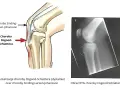 Ilustracja anatomiczna i RTG kolana pokazujące lokalizację choroby Osgood-Schlattera.