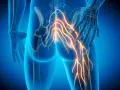 Anatomia: nerw udowy, który unerwia mięśnie uda i piszczeli, ukazany jako świetliste włókna biegnące od miednicy w dół nogi.