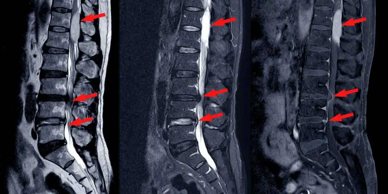 Obraz MRI kręgosłupa lędźwiowego z widocznymi zmianami wskazującymi na stenoza względna i bezwzględna. Czerwone strzałki zaznaczają zwężenia kanału kręgowego.