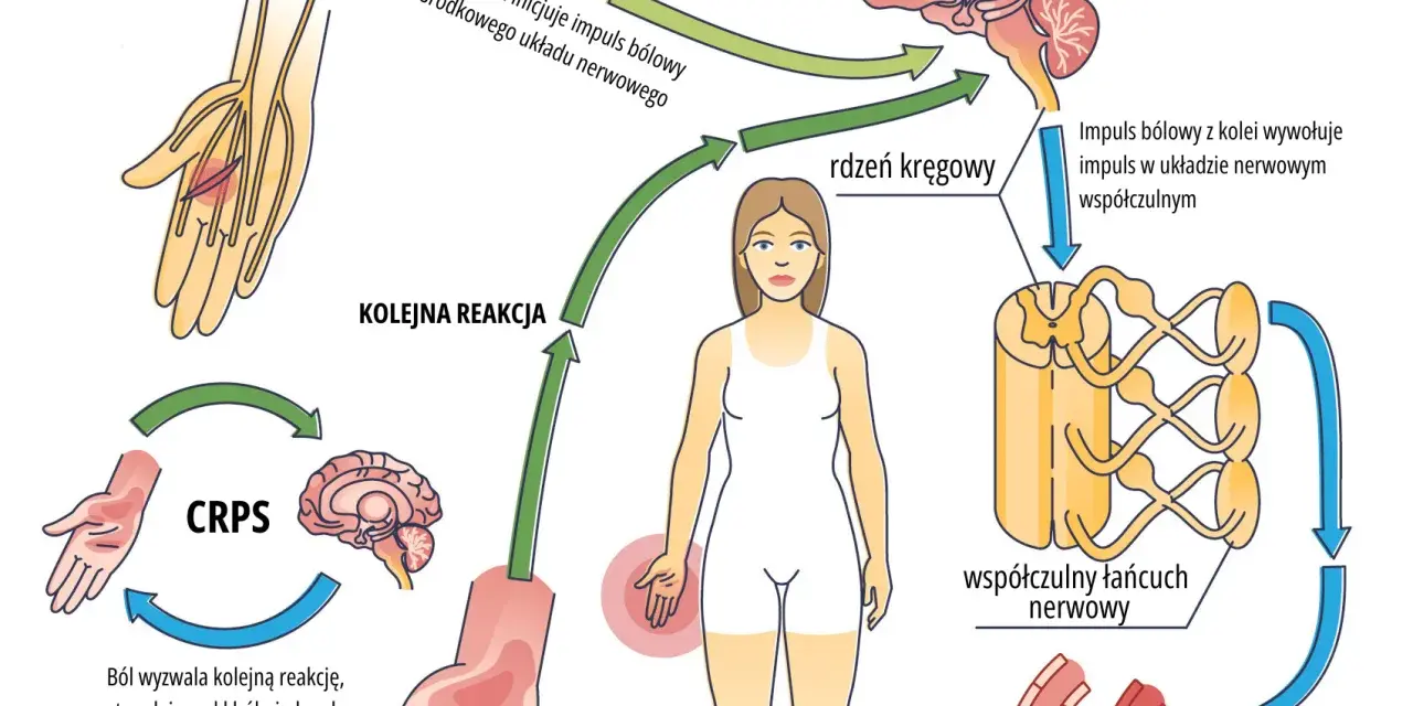 Cykl CRPS: uraz inicjuje ból, który przez rdzeń kręgowy i układ współczulny wywołuje kolejne reakcje, utrwalając ból i obrzęk.
