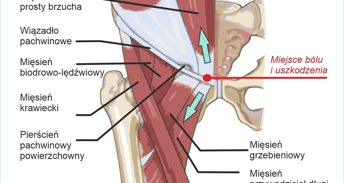 Anatomia pachwiny z zaznaczonym miejscem bólu i uszkodzenia, sugerującym problem z kręgosłupem.