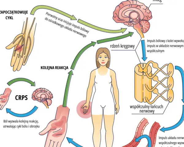Cykl CRPS: uraz inicjuje ból, który przez rdzeń kręgowy i układ współczulny wywołuje kolejne reakcje, utrwalając ból i obrzęk.