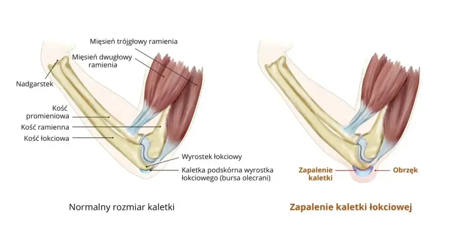 Porównanie zdrowej kaletki łokciowej z jej zapaleniem i obrzękiem. Ilustracja pokazuje anatomię łokcia i skutki zapalenia kaletki łokciowej.