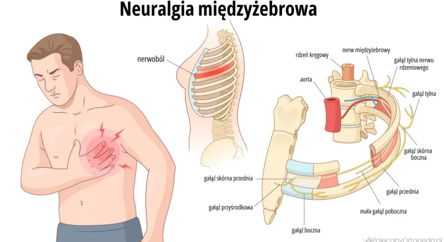 Ilustracja przedstawia mężczyznę z bólem w klatce piersiowej, wskazującym na neuralgia potyliczna objawy. Pokazuje unerwienie żeber i kręgosłupa.