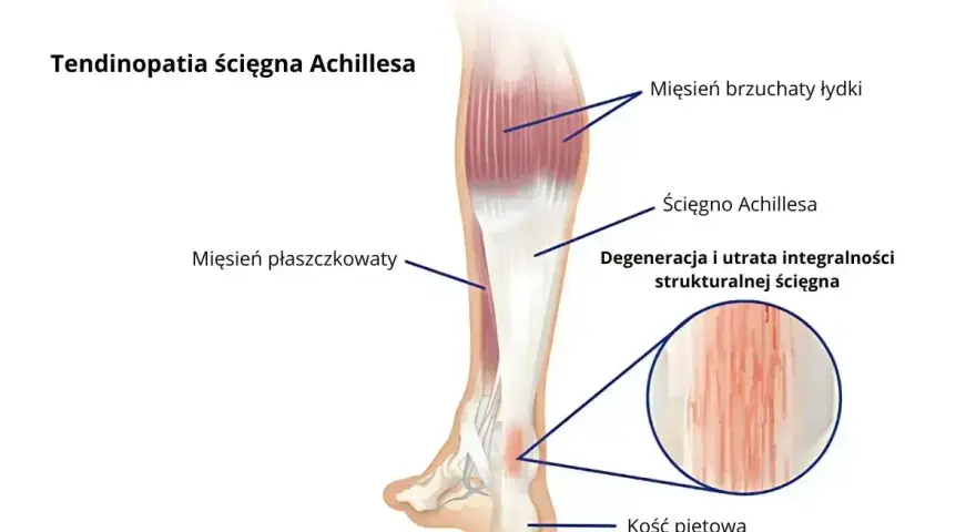 Anatomia podudzia człowieka z zaznaczonym ścięgnem Achillesa, mięśniami i kością piętową. Widoczna degeneracja ścięgna.