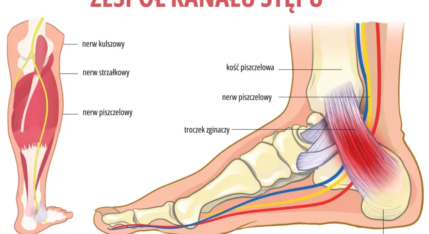 Ilustracja pokazuje anatomię stopy i łydki, z zaznaczonym nerwem piszczelowym. Może pomóc zrozumieć neuropatię i jej objawy.