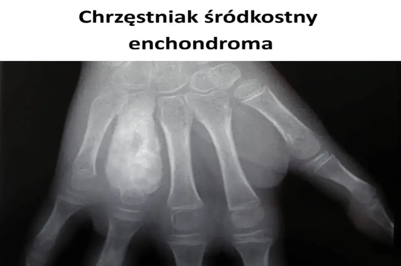 RTG dłoni z widocznym chrzęstniakiem śródkostnym (enchondroma). Rozważane jest leczenie.