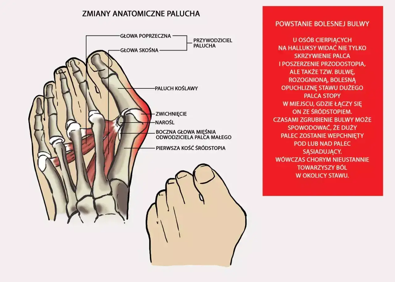 Anatomia palucha z zaznaczonym odwodzicielem palca małego, wskazującym na zmiany w stawie.