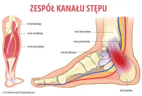 Ilustracja pokazuje anatomię stopy i łydki, z zaznaczonym nerwem piszczelowym. Może pomóc zrozumieć neuropatię i jej objawy.