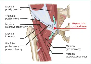 Anatomia pachwiny z zaznaczonym miejscem bólu i uszkodzenia, sugerującym problem z kręgosłupem.