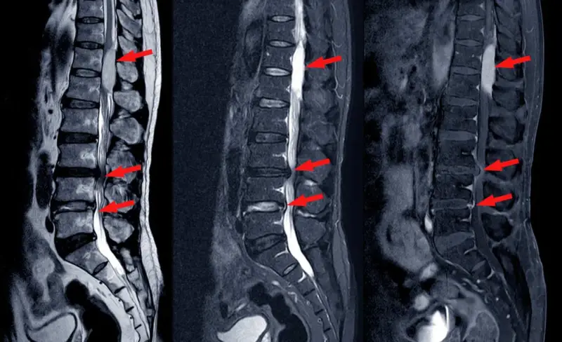 Obraz MRI kręgosłupa lędźwiowego z widocznymi zmianami wskazującymi na stenoza względna i bezwzględna. Czerwone strzałki zaznaczają zwężenia kanału kręgowego.