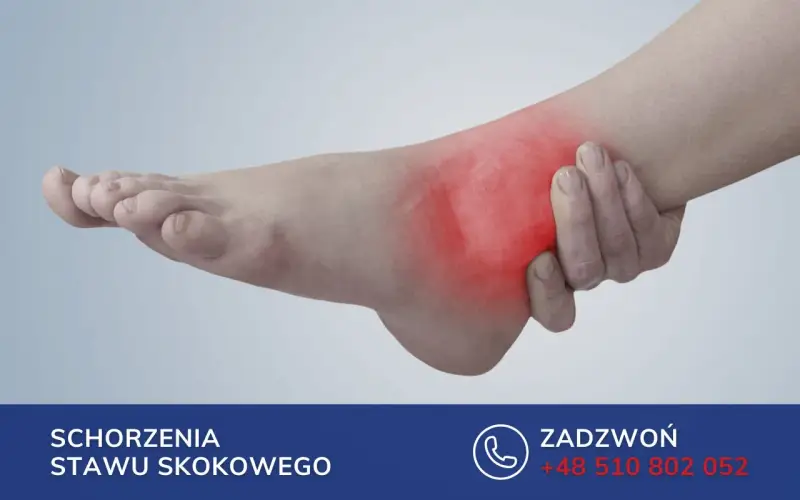 Ból w okolicy stawu skokowego, gdzie może być uszkodzone ścięgno strzałkowe. Czerwony obszar wskazuje na stan zapalny.