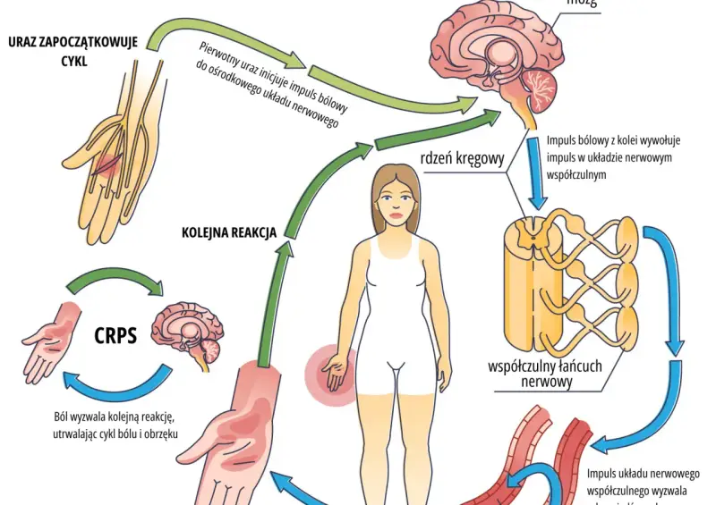 Cykl CRPS: uraz inicjuje ból, który przez rdzeń kręgowy i układ współczulny wywołuje kolejne reakcje, utrwalając ból i obrzęk.