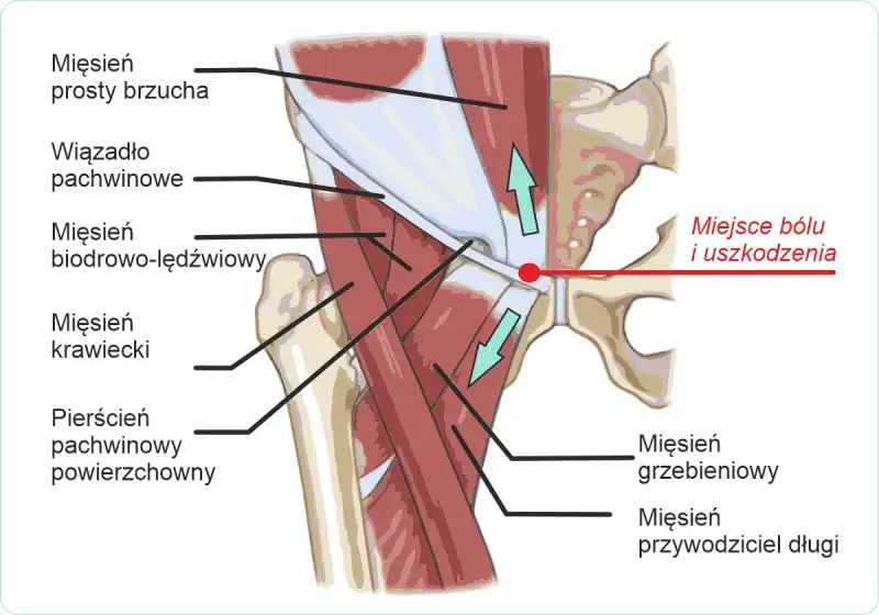 Anatomia pachwiny z zaznaczonym miejscem bólu i uszkodzenia, sugerującym problem z kręgosłupem.